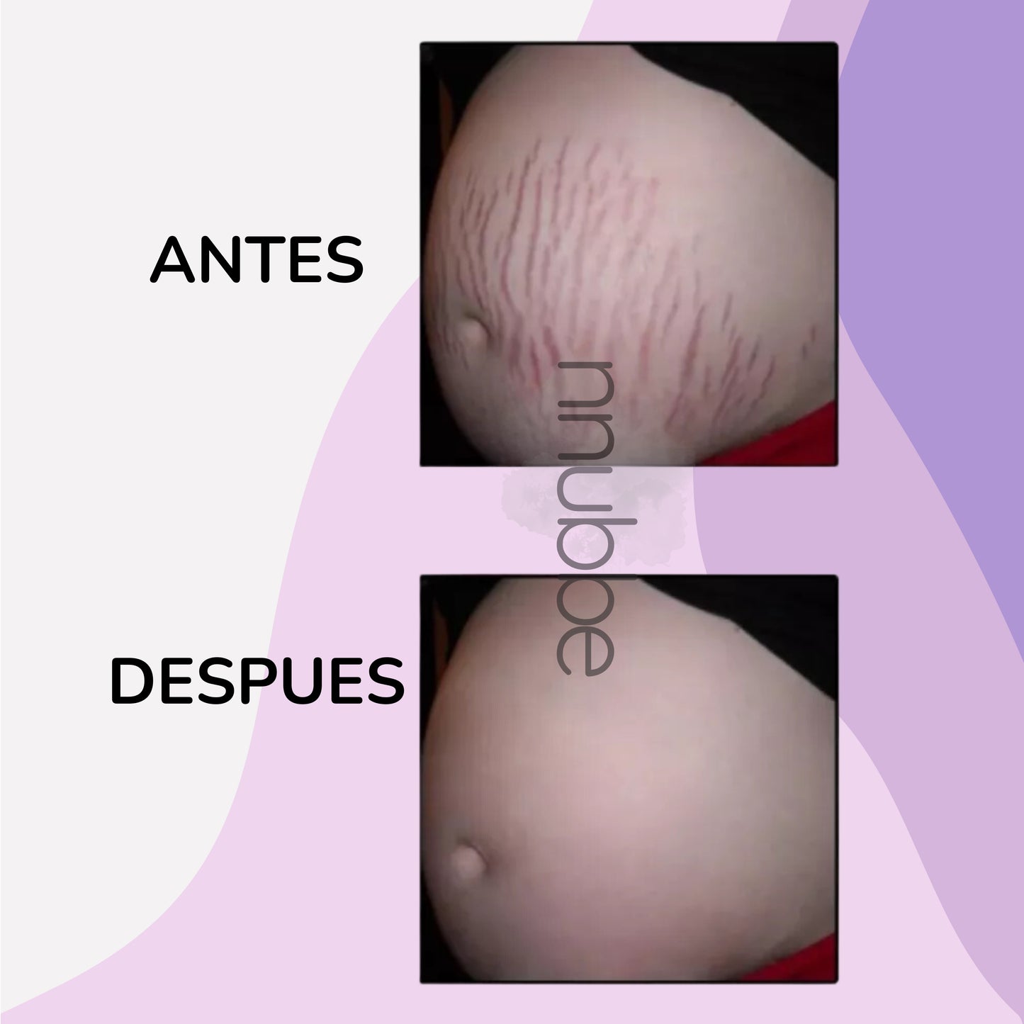 SERUM REMOVEDOR DE ESTRIAS ESSENTIAL ™